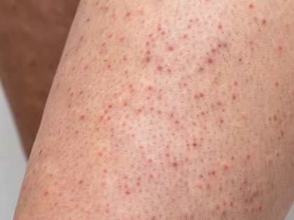 Legskin,Macro,Of,A,Young,Woman,Suffering,From,Pillar,Keratosis,